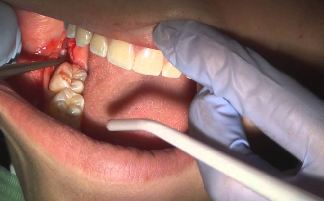 Nhổ răng số 8 hàm dưới khi nào và có nguy hiểm không
