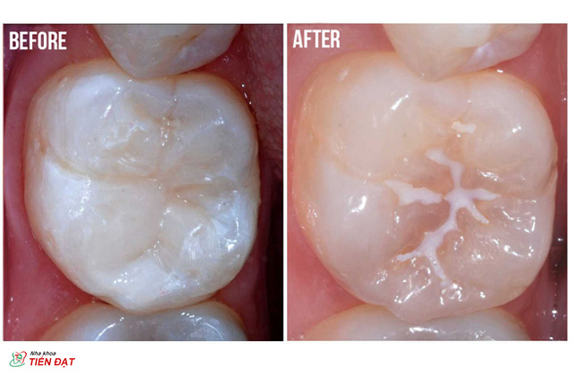 Biện pháp trám bít hố rãnh phòng ngừa sâu răng hiệu quả