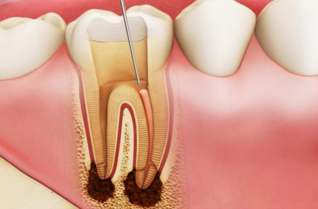 Điều trị viêm tủy răng trẻ em có ảnh hưởng đến răng vĩnh viễn sau này không?