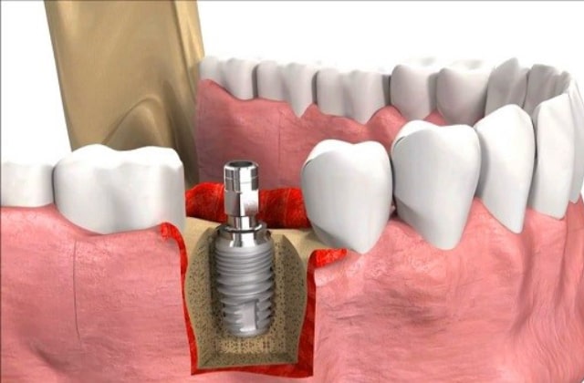 Ghép xương trong cấy ghép implant, phẫu thuật ghép xương răng