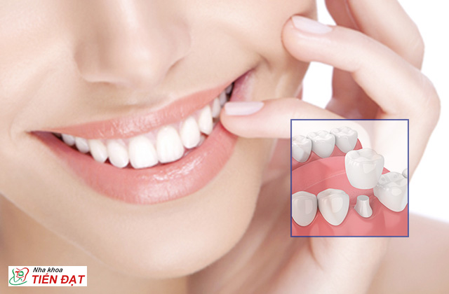 Bọc răng sứ có ảnh hưởng gì không? Những lời khuyên từ bác sĩ 